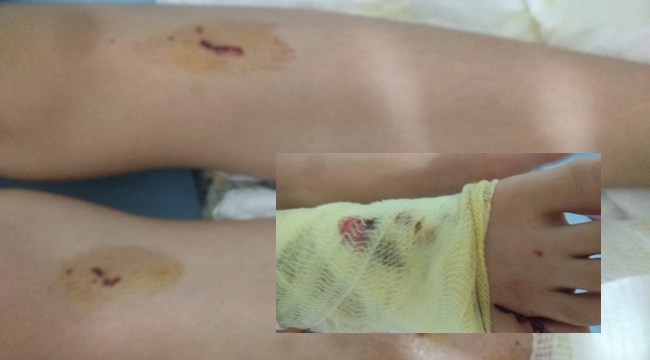 Balkona fırlatılan torpil balkonda uyuyan çocuğu yaraladı