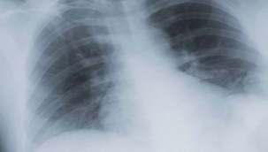 KOAH nedir? Belirtileri nelerdir? 