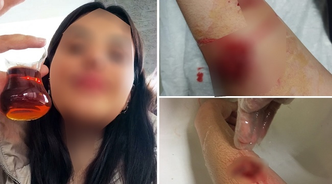 Şanlıurfa'da köpek dehşeti: Üniversite öğrencisi yaralandı